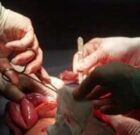 خارج کردن تومور پیشرفته ویلمز از کلیه کودک ۹ساله طی عمل جراحی ۶ ساعته