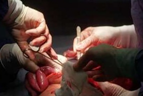 خارج کردن تومور پیشرفته ویلمز از کلیه کودک ۹ساله طی عمل جراحی ۶ ساعته